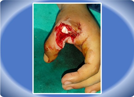 FINGER INJURY